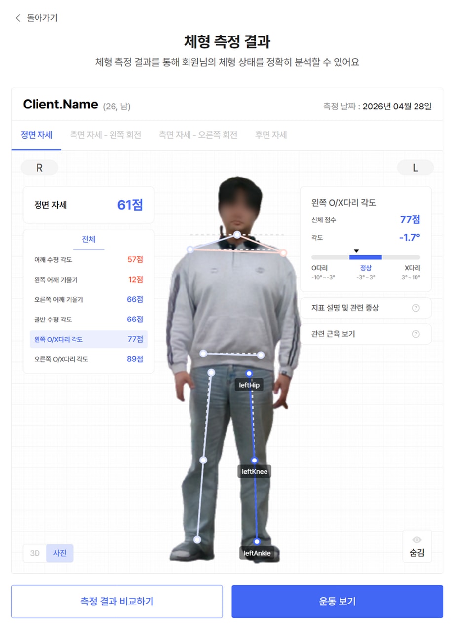 OX 다리 - 왼쪽