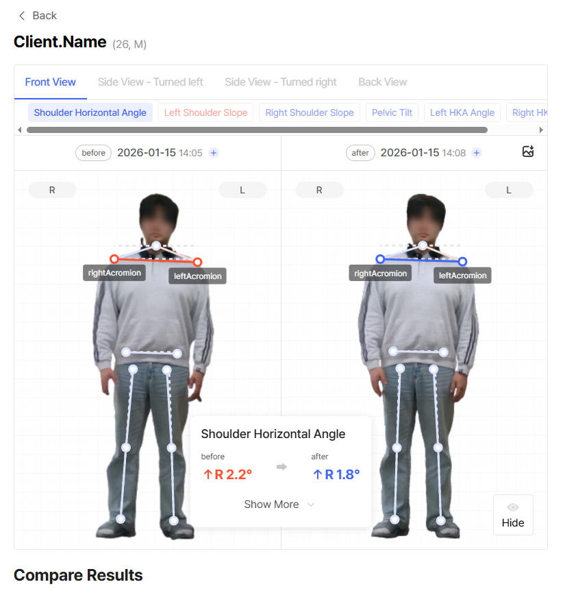 Before and After(Front view)