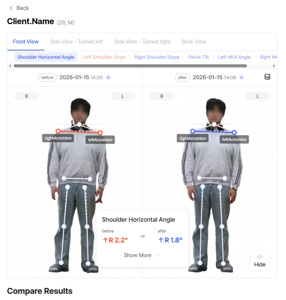 Before and After(Front view)