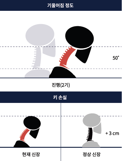 거북목 진행 정도(일러스트)